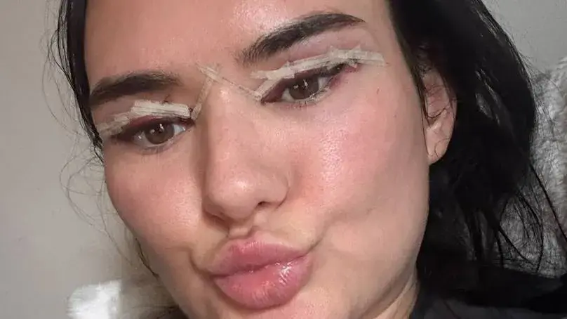 Woman left 'crying blood' at airport after £600 influencer eyelid surgery gone wrong