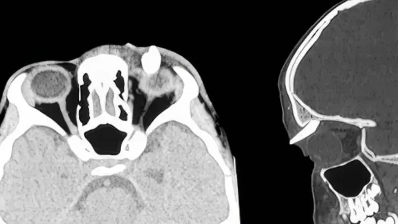 Teenage boy has tooth growing from eye socket in rare medical case